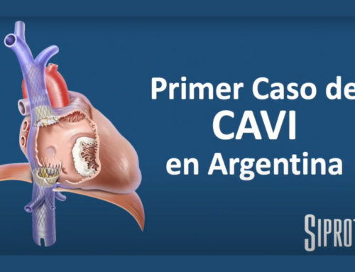 Primer procedimiento CAVI en Argentina